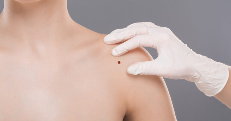 Dermatologist examining birthmark on woman shoulder, closeup. Cancer prevention concept, empty space