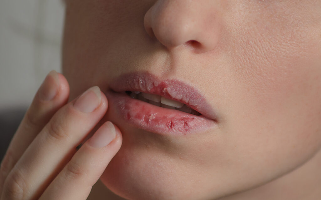 Dermatillomania skin picking. Woman has bad habit to pick her lips. Harmful addiction based on anxiety stress and dry lips. Excoriation disorder. Sick cracked damaged tissue.